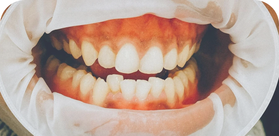 malocclusion-dentaire-mont-blanc-orthodontie-cluses