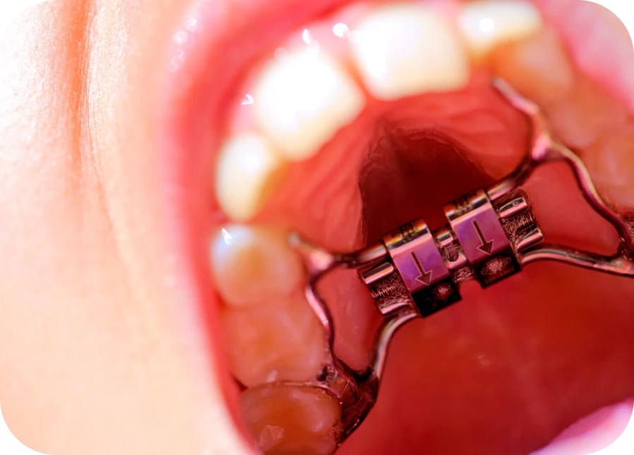 appareil-fixe-disjoncteur-docteur-chavez-cluses